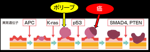 大腸がんは多くが大腸ポリープが時間をかけてがん化したものです。