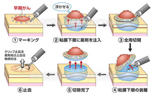 ESD（早期がんの内視鏡治療）01