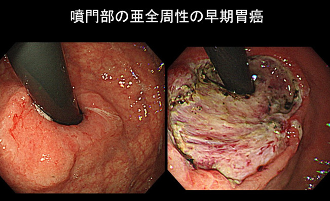 ESD（早期がんの内視鏡治療）02