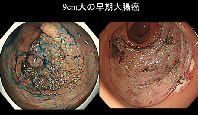 ESD（早期がんの内視鏡治療）03