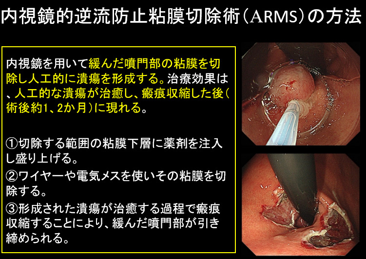 ARMS（逆流性食道炎の内視鏡治療）01