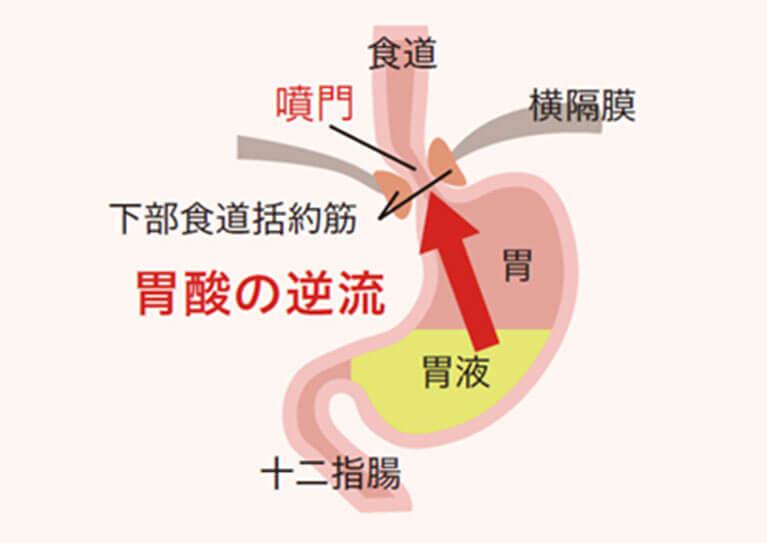 逆流性食道炎とは