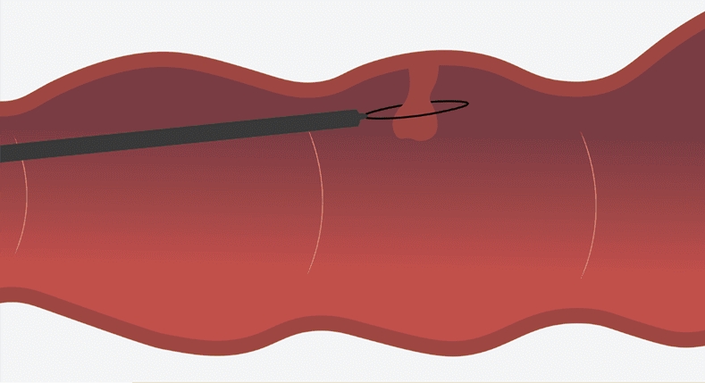 日帰り治療可能な大腸ポリープ切除