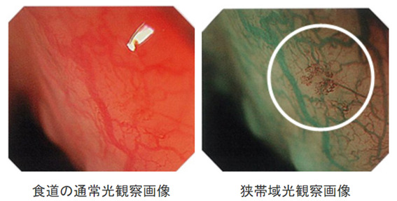 がんの早期発見率を向上させる拡大内視鏡検査